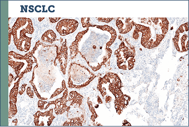 NSCLC Image